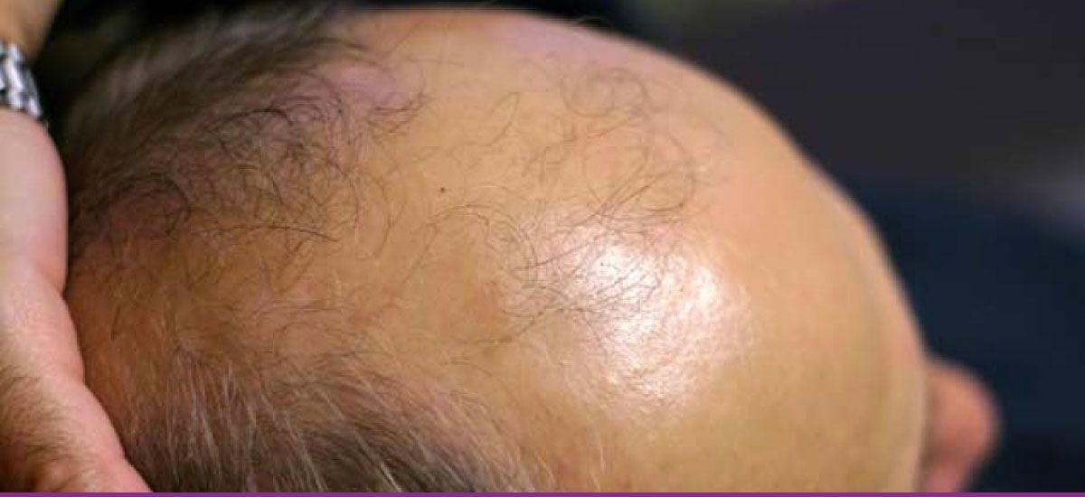 Alopecia Androgenética (Calvicie Común)