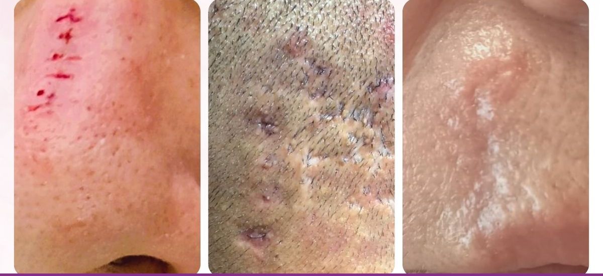 Cicatrices en Dermatología