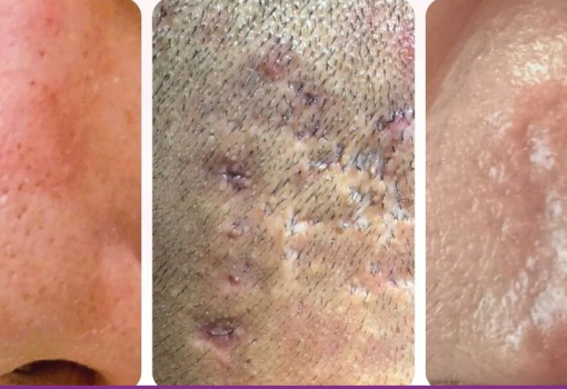 Cicatrices en Dermatología