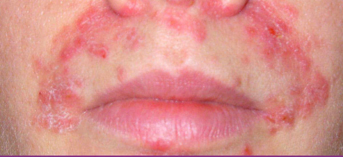 Dermatitis Perioral