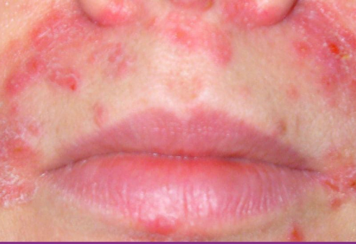 Dermatitis Perioral