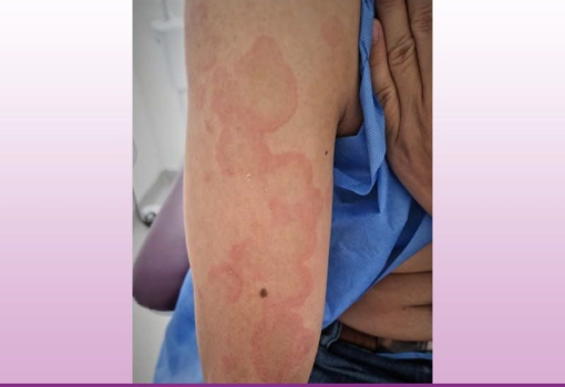 Urticaria Vasculitis