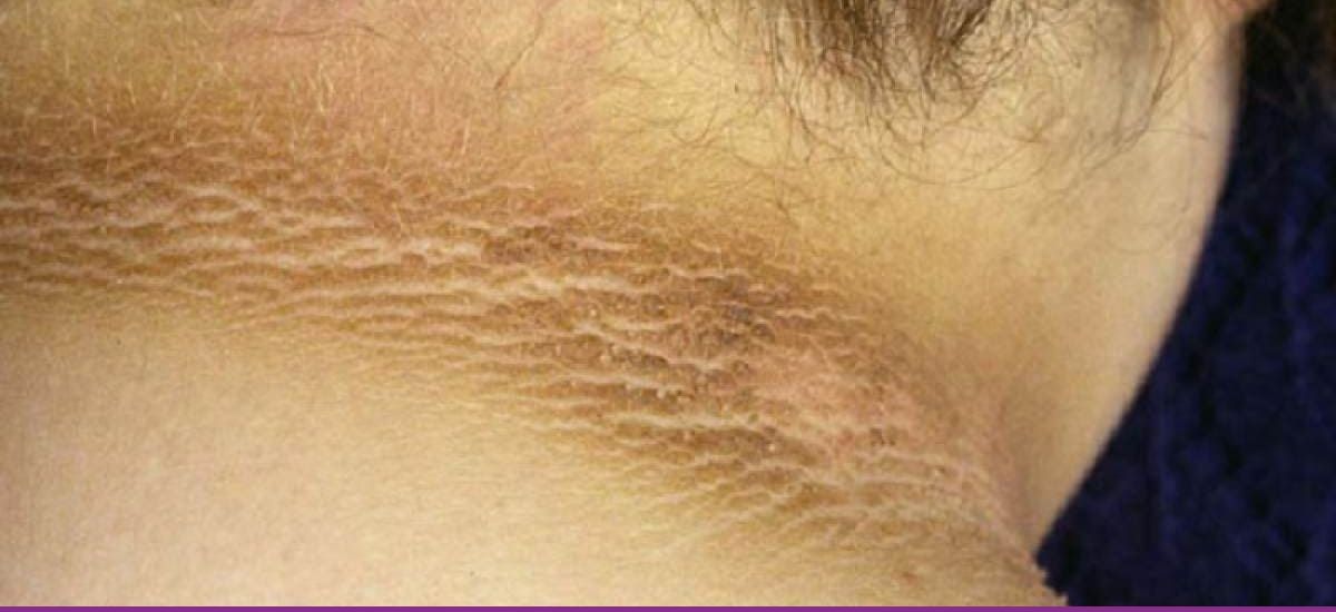 Acantosis Nigricans
