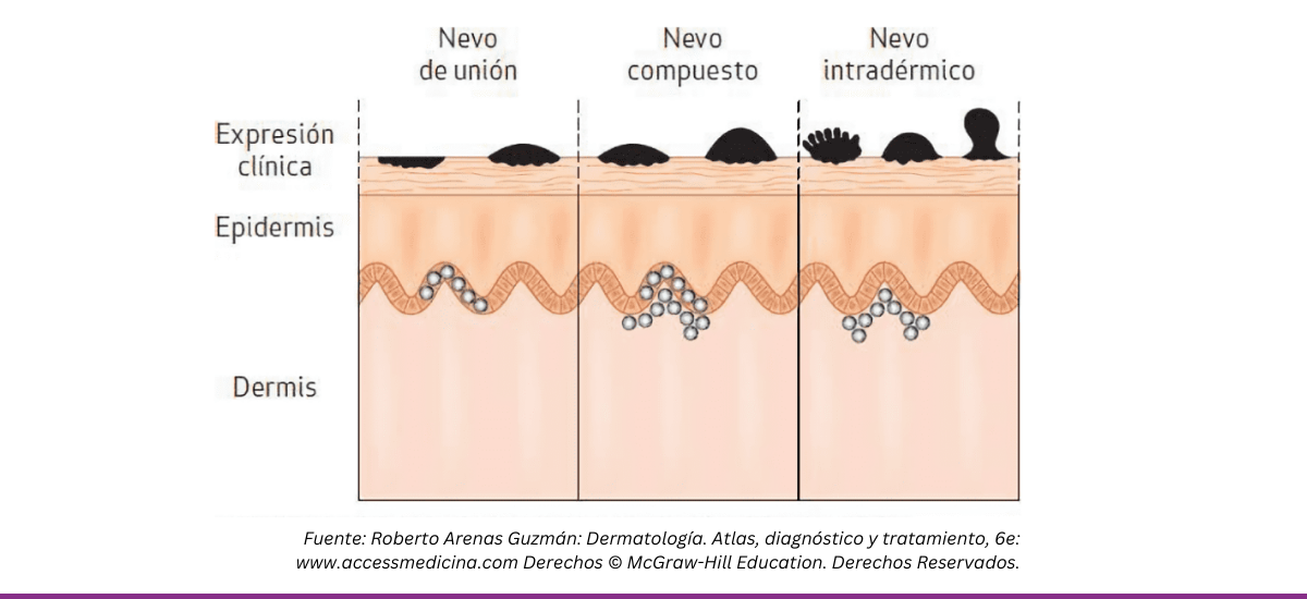 Nevos comunes