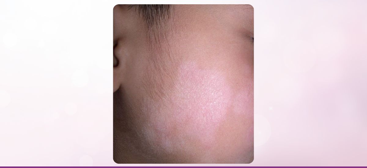 Pitiriasis Alba