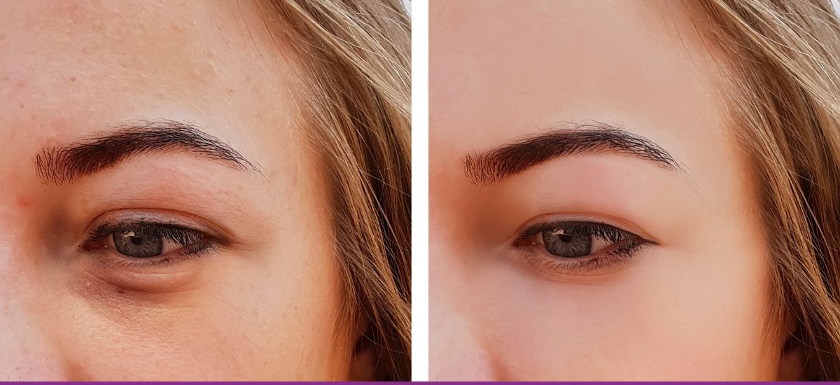Relleno de Ojeras