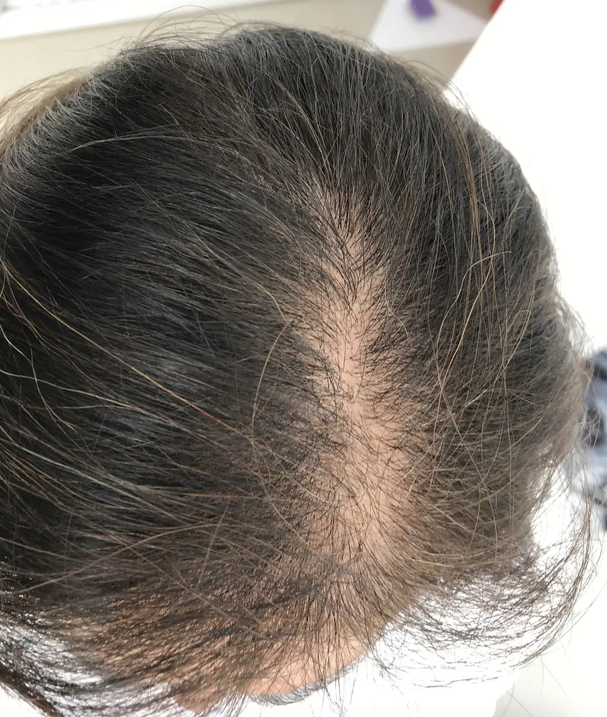 Alopecia Androcronogenética