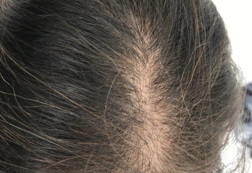 Alopecia Androcronogenética