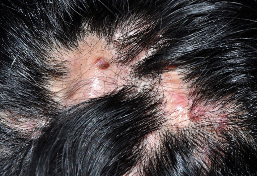 Foliculitis Decalvante