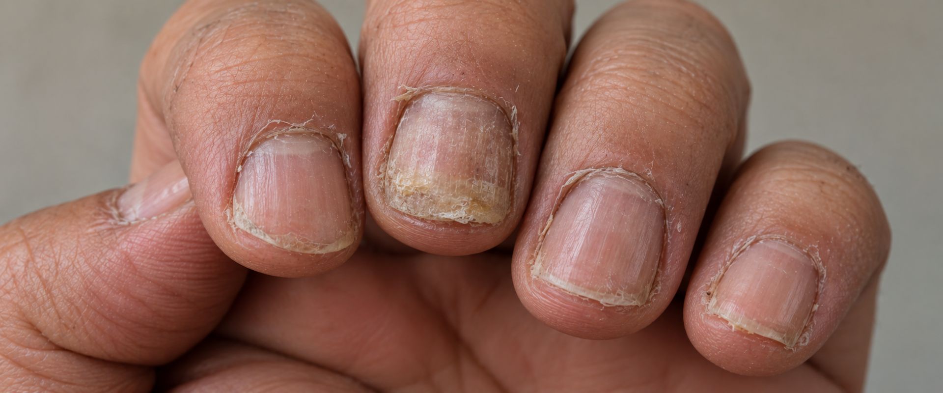 Clínica de enfermedades de las uñas - Diagnóstico y manejo integral especializado