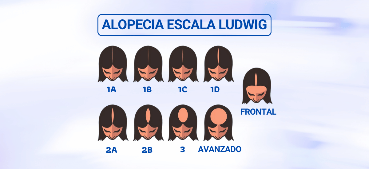 Alopecia Androcronogenética